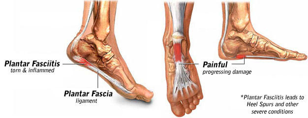 plantar fasciitis pain. the plantar fascia is to